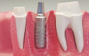 Implantes dentales