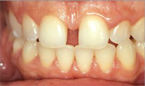 Carnillas estéticas de composite