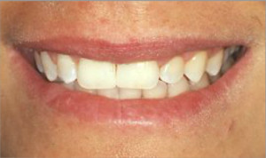 Carnillas estéticas de composite