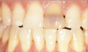 Blanqueamiento interno