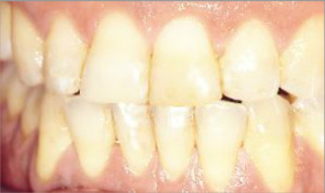 Blanqueamiento interno