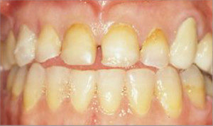 Rehabilitación completa, fundas de porcelana y tratamiento periodontal