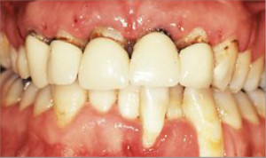 Rehabilitacón completa sobre implantes