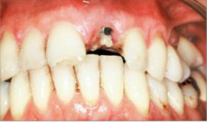 Rehabilitación unitaria sobre implante