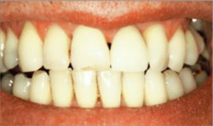 Rehabilitación unitaria sobre implante