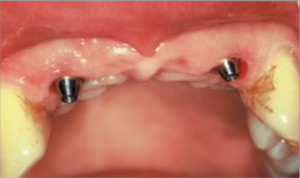 Rehabilitación sobre dos implantes