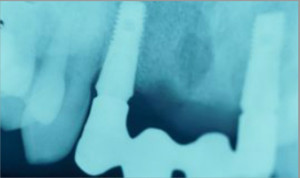 Rehabilitación sobre dos implantes