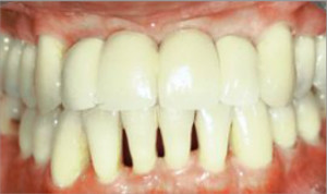 Rehabilitación sobre dos implantes