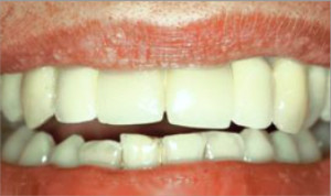 Rehabilitación sobre dos implantes