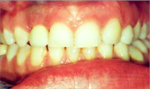 Ortodoncia e implantes