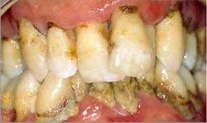 Tratamiento periodontal y estética dental