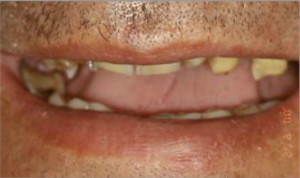 Rehabilitación completa con fundas de metal- porcelana