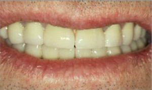 Rehabilitación completa con fundas de metal- porcelana