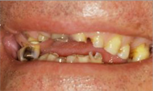 Rehabilitación completa con fundas de porcelana