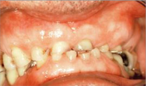 Rehabilitación completa con fundas de porcelana