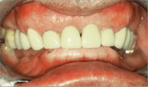 Rehabilitación completa con fundas de porcelana