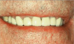 Rehabilitación completa con fundas de porcelana